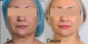 Как избавиться от двойного подбородка