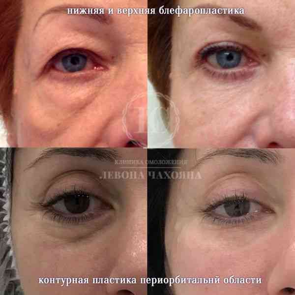 7 эффективных способов скрыть круги под глазами с помощью косметики
